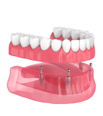 Implantes Dentales All on Four