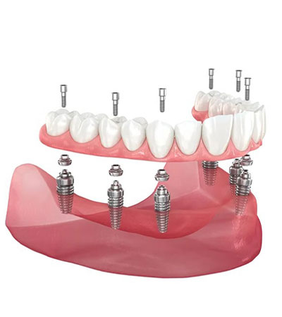 Implantes Dentales Full Arch