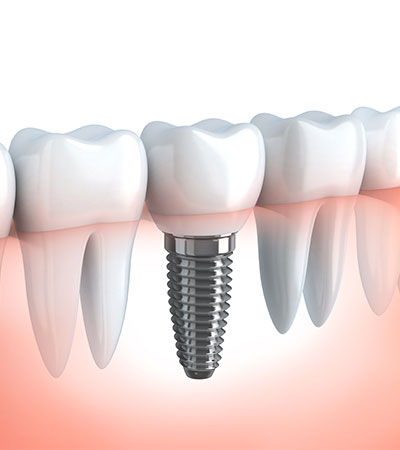 Implantes Dentales Unitarios