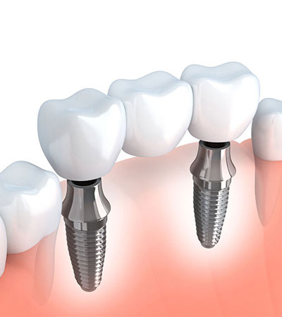 Puente Sobre Implantes Dentales
