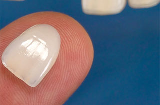 Razones por las que deberías usar carillas dentales