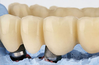 Conoce las diferencias entre coronas y puentes dentales