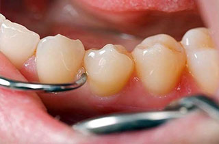 El poder del curetaje dental