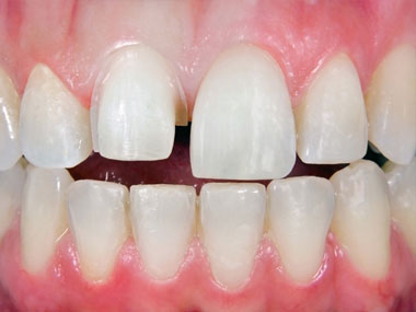 Carillas Dentales Antes