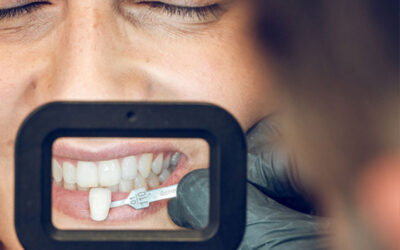 Conoce los beneficios de las carillas dentales