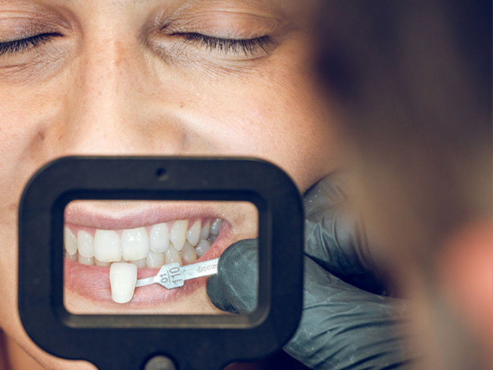 Carillas dentales beneficios