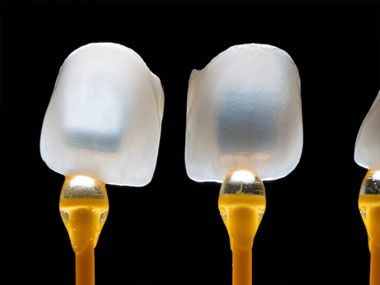 Carillas dentales de composite