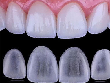Carillas dentales de porcelana