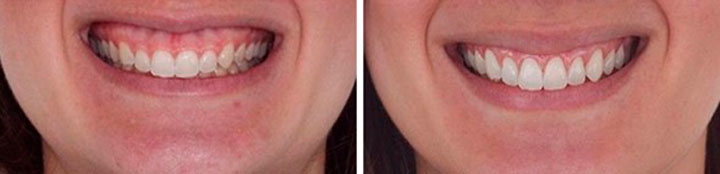 Cuidados despues de Gingivectomía