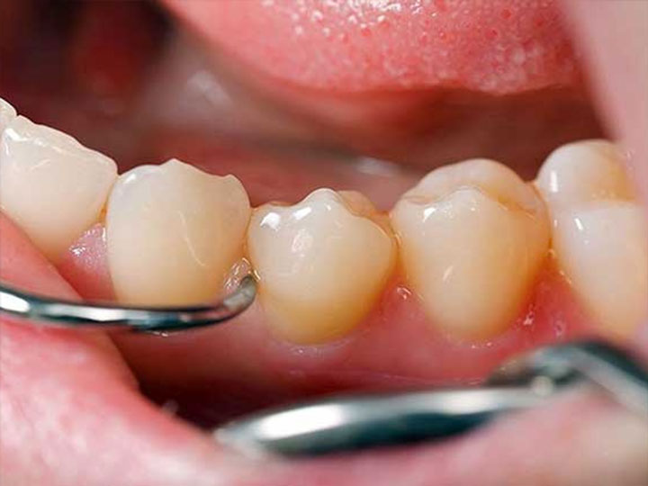 Curetaje Dental