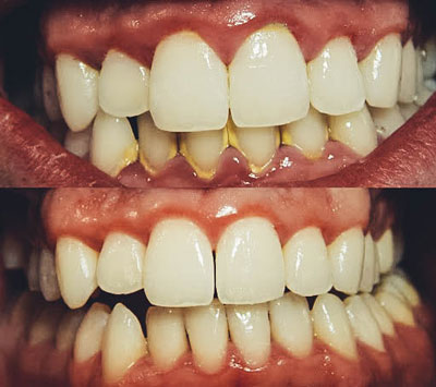 Enfermedad periodontal