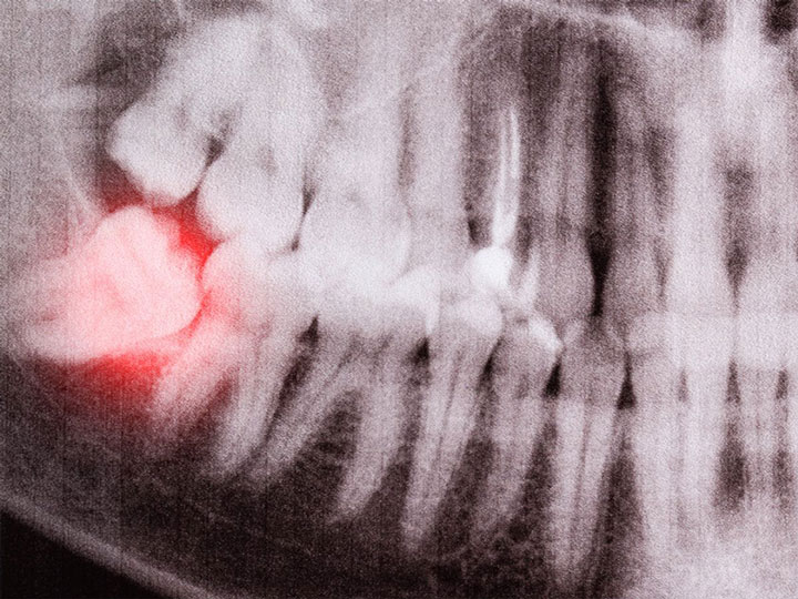 Extracción de muelas del Juicio