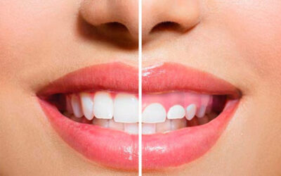 ¿Qué es la gingivectomía?