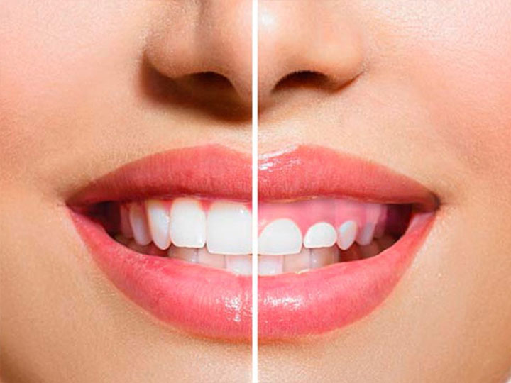 Gingivectomía que-es