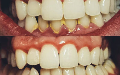 ¿Por qué se produce el sarro debajo de las encías y cómo prevenirlo?