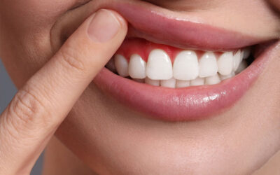 Consecuencias de no hacerse limpiezas dentales