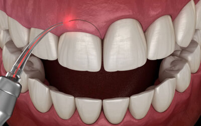 Cuidados después de una gingivectomía